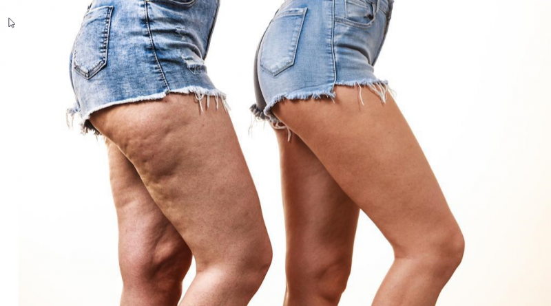 cellulite on thighs